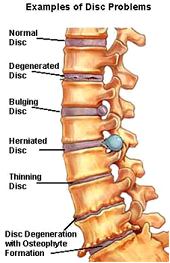 Spondylosis